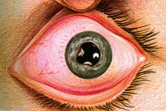 Iridocyclite : pupille déformée et œil rouge